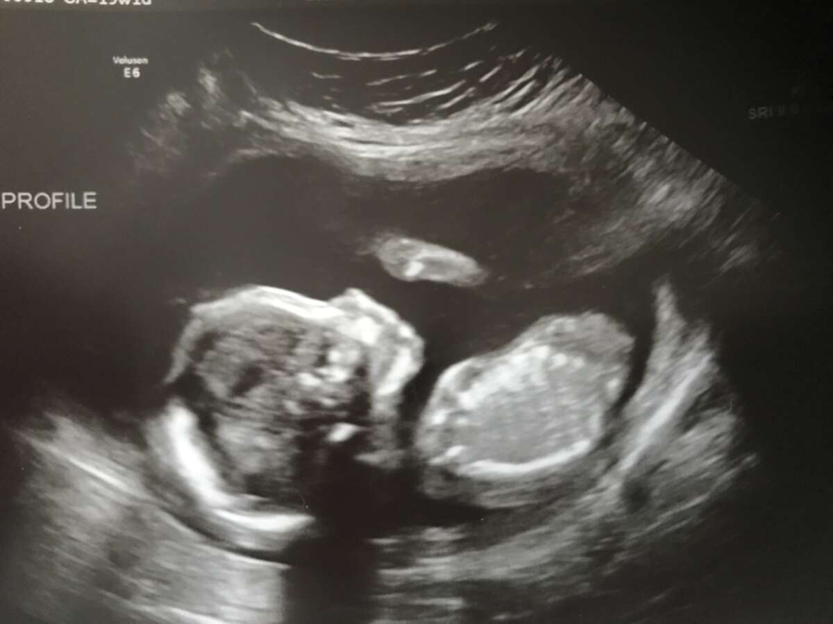 When Can You Find Out The Gender Of A Baby